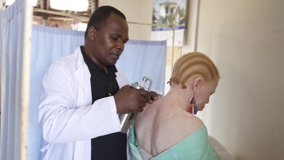 Association decries spate of skin cancer among albinos/Illustration. 