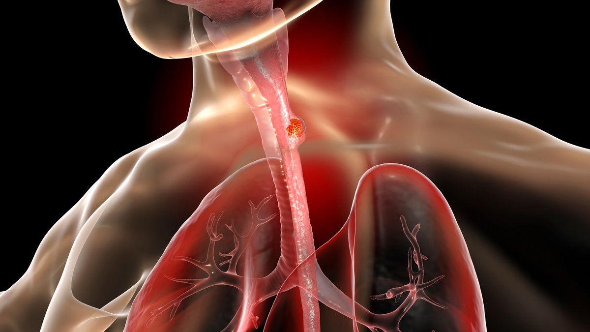 Pacijenti bez vidljivog Barrett-ovog jednjaka imali su uznapredovali rak u istraživanju 