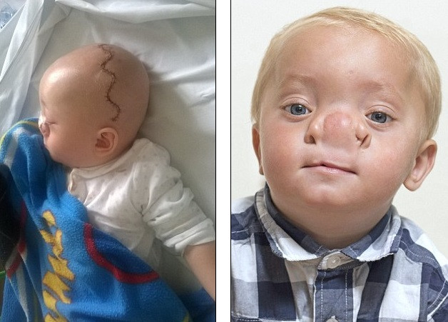 Tak wygląda chłopiec po operacji