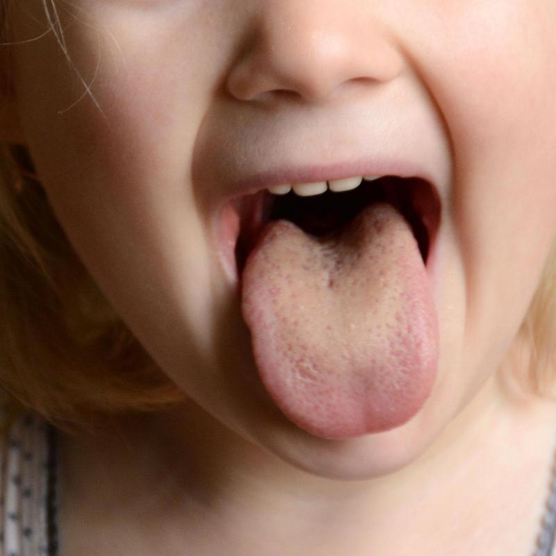 Żółty język – u dzieci i dorosłych. Jakie są przyczyny i kiedy jest powodem  do niepokoju.