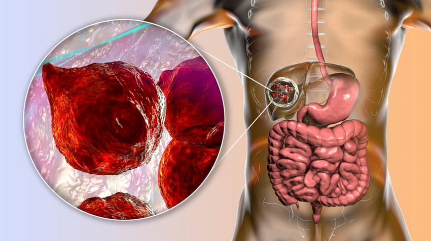 máj, májciszta, ultrahang, vizsgálat, endometriózis, orvos válaszol