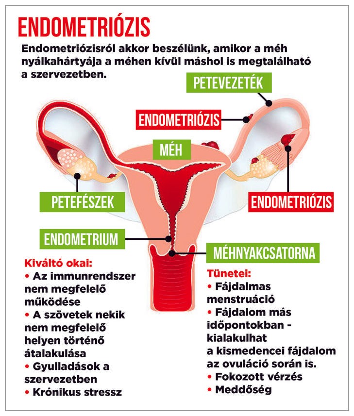 Grafikánkon látszik, hogy hogyan alakul ki a betegség és milyen tünetekkel hívja fel magára a figyelmet / Grafika: Séra Tamás