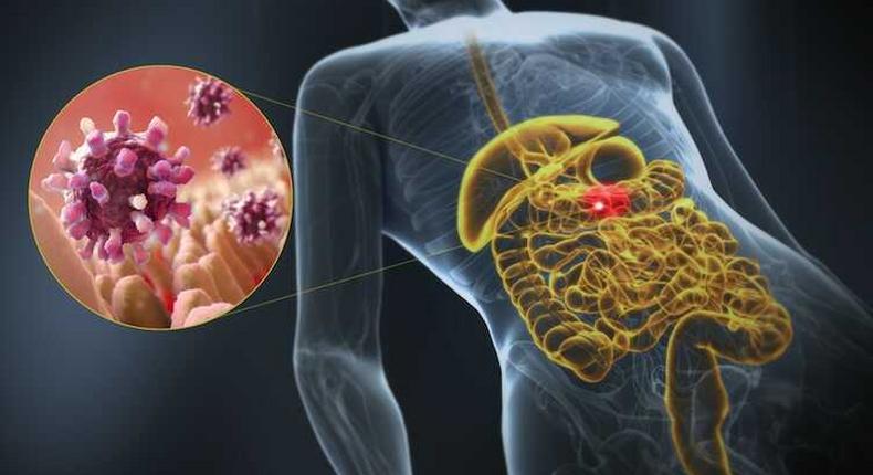 Gastroenteritis, a 3D medical illustration of affected organ highlight