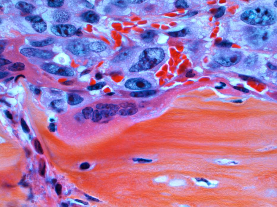 A rák mikroszkópikus színei. Ezek lehetnek a korai tünetei. / Fotó: Northfoto