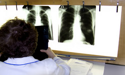 Sposób na bardzo wczesne wykrycie raka płuca. Lekarze apelują, by się zgłaszać