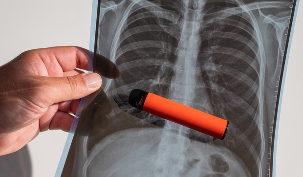 Kokičasta pluća najčešće nastaju kod korisnika koji se izlažu određenim hemikalijama