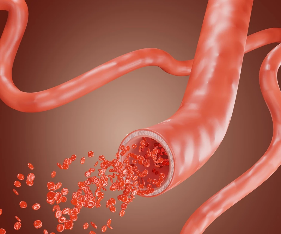 Gubitak više od 30 odsto ukupne zapremine krvi može dovesti do ozbiljnih simptoma i komplikacija među kojima je i hipovolemijski šok 