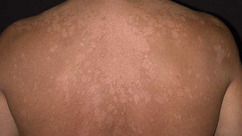 Ringworm Here Are The Possible Causes And Home Remedies For This