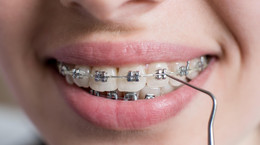 Jak przygotować się do założenia aparatu ortodontycznego? Konsultacje, higiena i koszty leczenia ortodontycznego