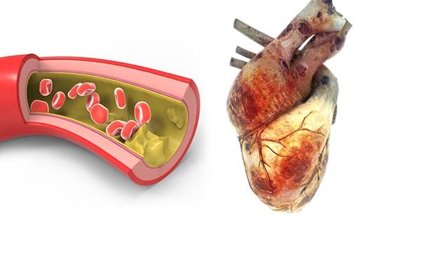 fogászati egészséggel összefüggő szívbetegség)