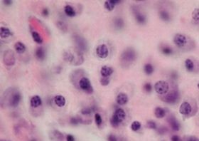 myeloma-multi-d00000A9A8fb7747e6f9a