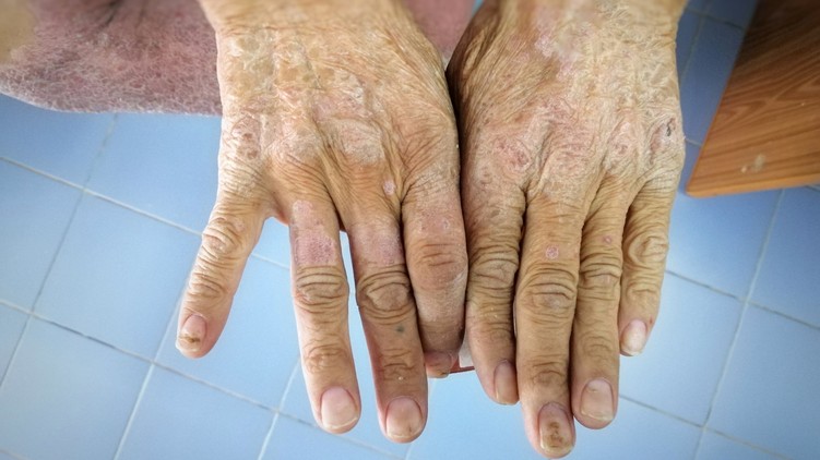 Kemény érdes bőr oka scleroderma bőrbetegség