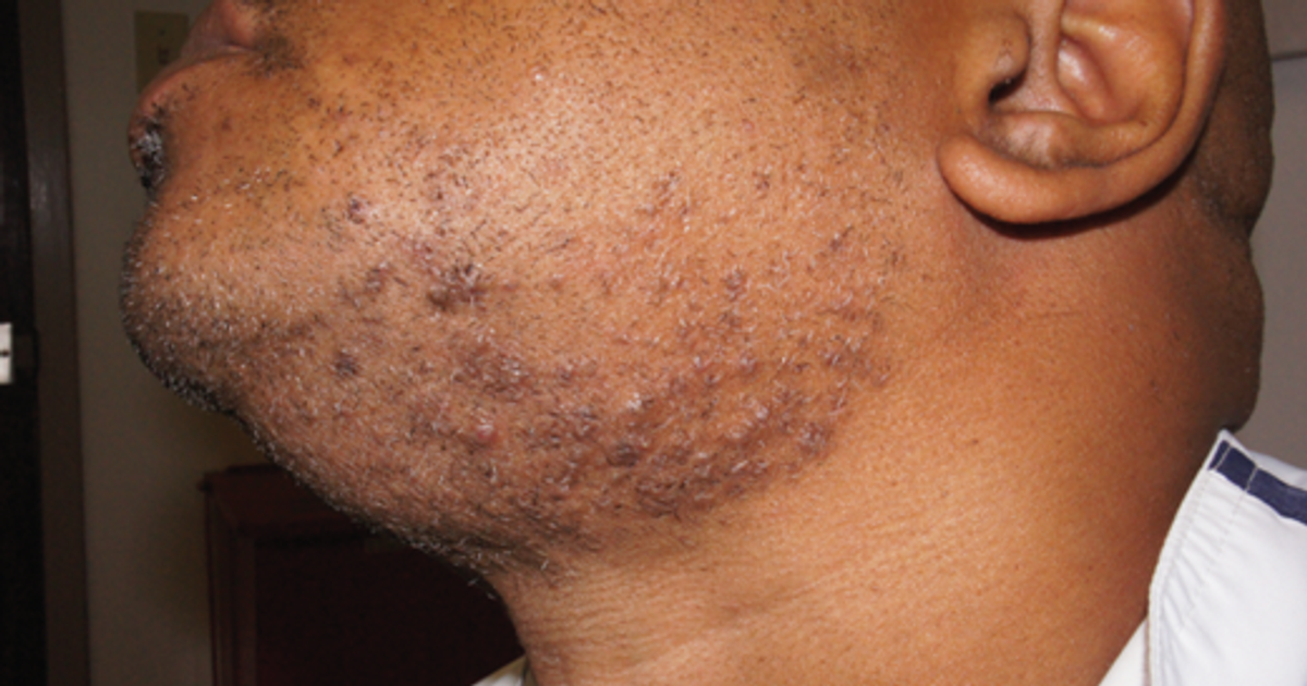 5-fast-ways-to-treat-razor-bumps-at-home-pulse-ghana