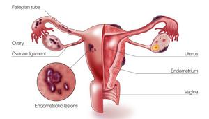 A diagram showing how endometriosis occurs in female reproductive organs