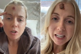 "Moja bubuljica na čelu ZAPRAVO JE BILA RAK, a ove simptome sam uporno ignorisala": Mlada mama dala JEZIVO UPOZORENJE ženama