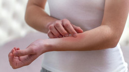 Poznaj alergię na własnej skórze - pokrzywka. Rodzaje i sposoby leczenia pokrzywki