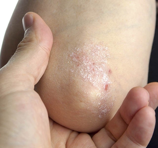 pikkelysömör ekcéma kezelése enyhíti a gyulladást psoriasis mi lesz ha nem kezelik