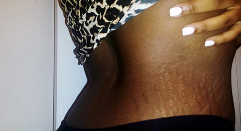 5 home remedies to treat stretch marks