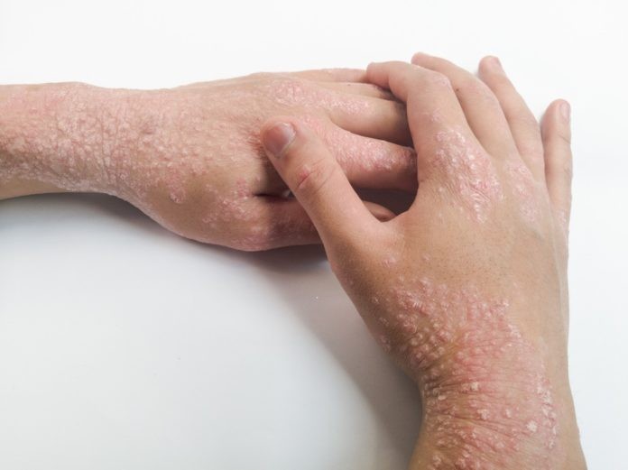 Your skin will react negatively to some bleaching creams [medicunis]