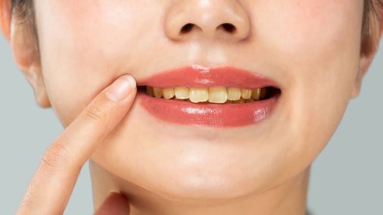 fogelszíneződés étel ital fog sárga