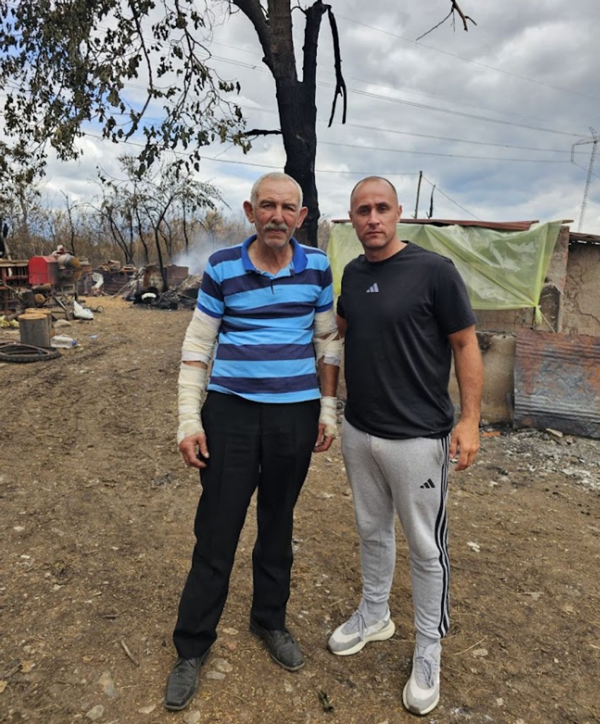 Čovek kome su obe ruke izgorele u požaru