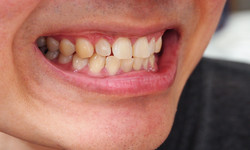 Jakie są domowe sposoby na żółte zęby? To radzi dentystka