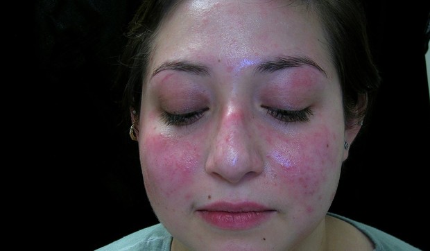 Lupus je prepoznatljiv po osipu na licu u obliku krila leptira 