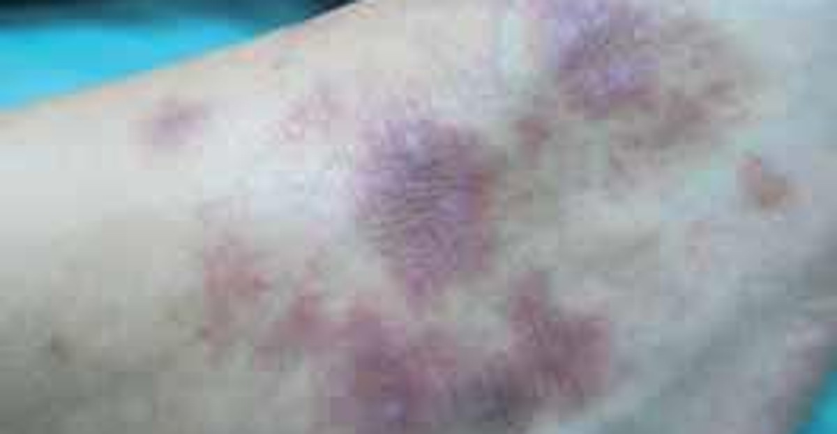 Liszaj czerwony płaski - przyczyny, objawy, zdjęcia, leczenie