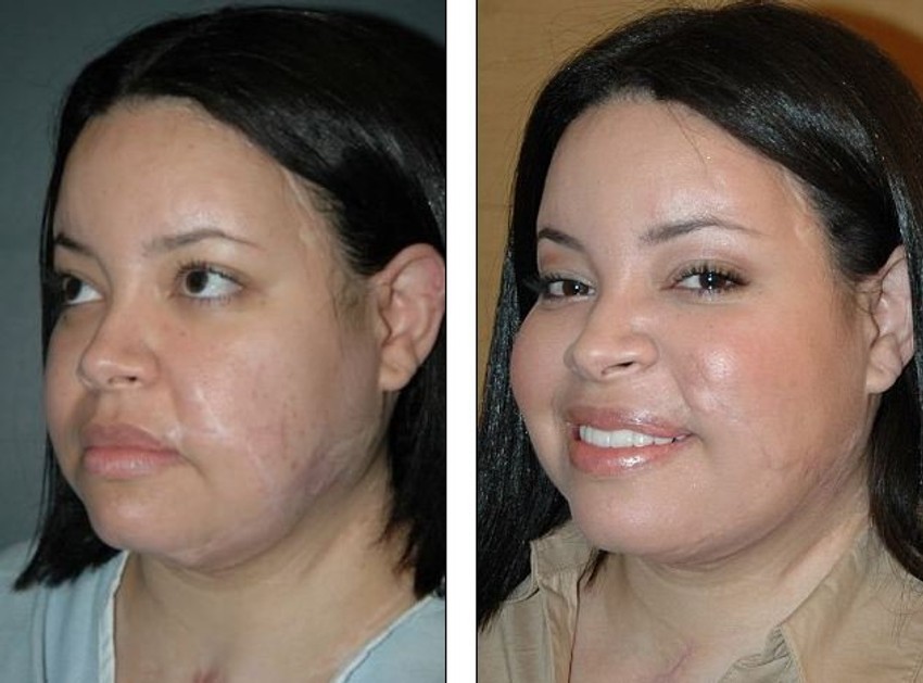 Ožiljci na licu uklonjeni su presađivanjem kože sa drugih delova tela