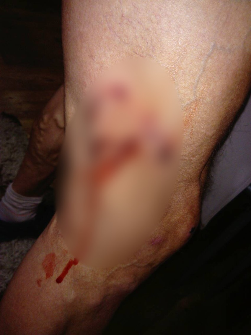 Noga maratonca Ace Krstića posle ujeda pasa lutalica