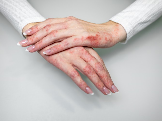 Kako nastaje i kako se leči psorijaza