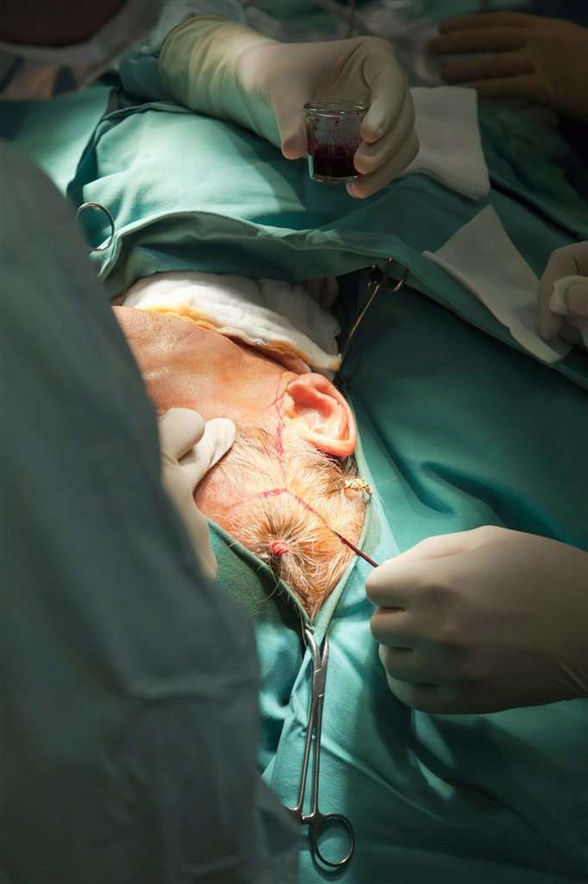 Niesamowita operacja w polskim szpitalu! Rak krtani pokonany. Drastyczne zdjęcia
