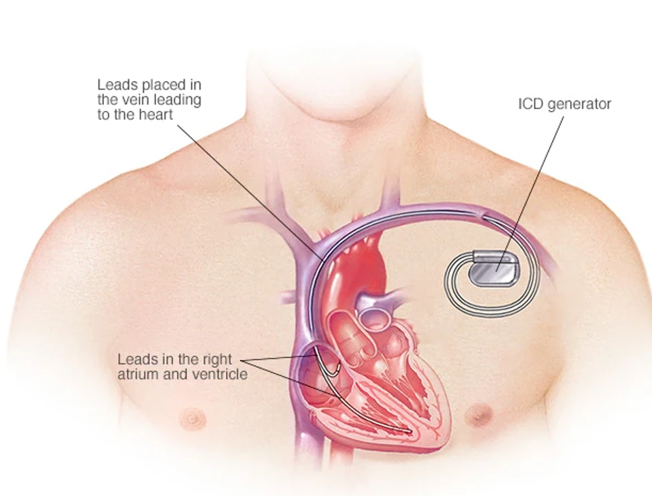Implantabilni kardioverter-defibrilator (ICD) kontroliše otkucaje srca tako što šalje šokove srcu kada uređaj otkrije nepravilan otkucaj srca