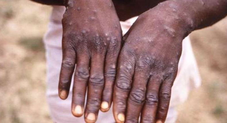 Cutar monkeypox