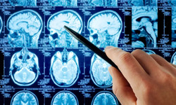 Jak witamina D wpływa na mózg? Chodzi o sprawność umysłową i ryzyko demencji