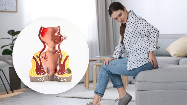 negyedik stádium előrehaladott aranyér tünete