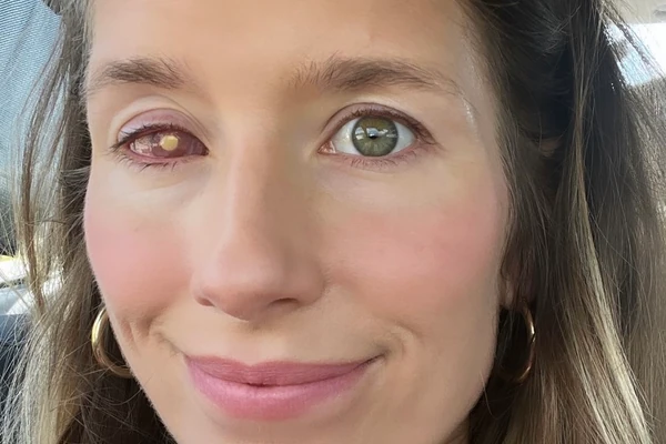 "Tuširala sam se sa SOČIVIMA, a onda je moje OKO napao PARAZIT ZBOG KOJEG SAM OSLEPELA": Poznat je kao i AMEBA koja JEDE MOZAK i aktivira se NAJČEŠĆE u kontaktu sa VODOM