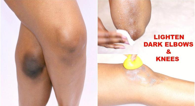 Here are 5 ways to naturally get rid of dark elbows and knees