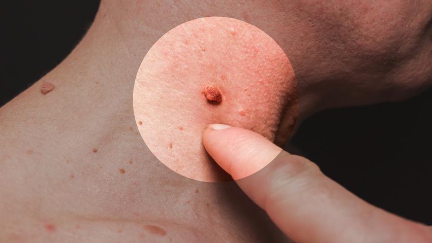 a szalagféreg egy ember az enterobiasis tabletta megelőzése