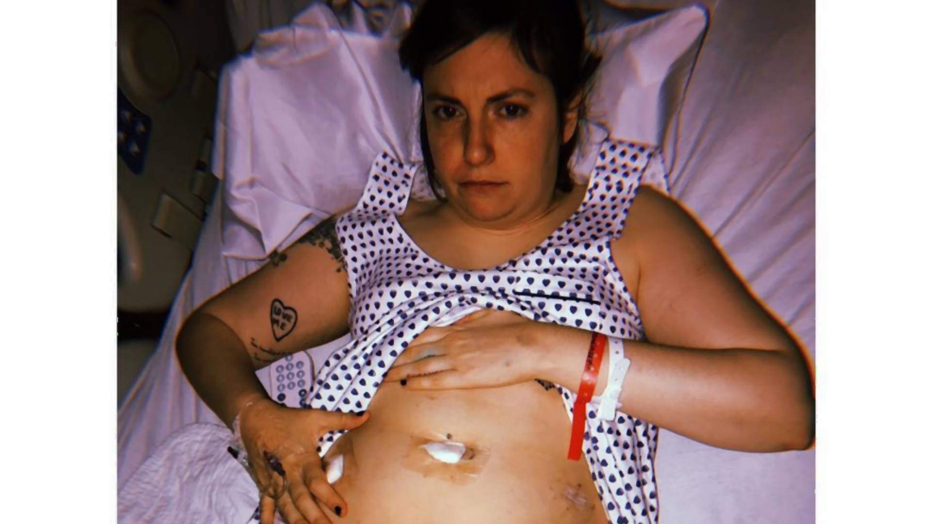 Po usunięciu macicy musiała usunąć także jajnik. Lena Dunham nadal toczy walkę z endometriozą