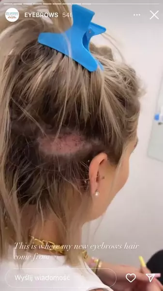 Mieszki włosowe przeszczepiono z tyłu jej głowy / Instagram Ofeminin