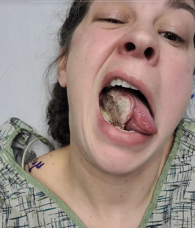 Racheline prvé príznaky lekár považované za príčinu jej Crohnovej choroby.