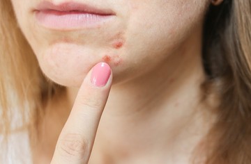 Amikor az arcbőr így néz ki, hormonzavar okozza a problémát