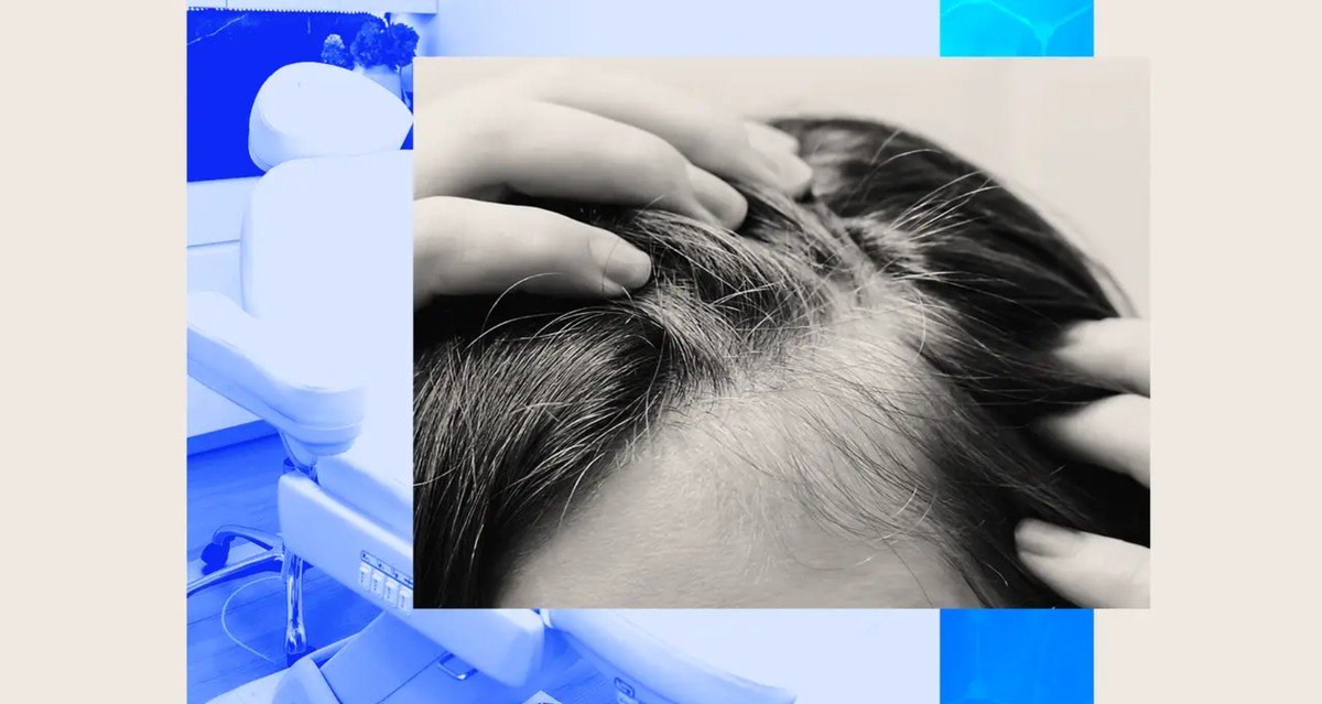 Przeszczep włosów? Zapomnij. Nowy laserowy zabieg ma być jak wizyta u dentysty dwa razy w roku