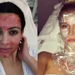 Stosują go Kim Kardashian, Gisele Bundchen i Joanna Krupa. Czym jest wampirzy lifting?