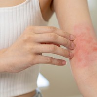 Így következtetheti ki a csípésnyomok alapján, hogy mi csíphette meg