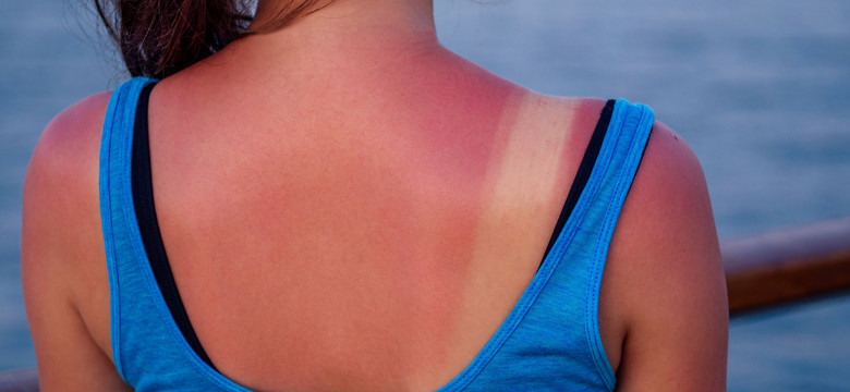 Oparzenia słoneczne: Jak szybko ukoić ból i zadbać o skórę?