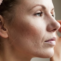 Pattanásos bőr felnőttkorban: ilyen kezelési lehetőségekben bízhat a szakértő szerint