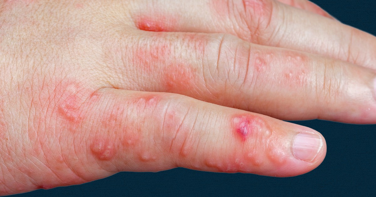 Wirus jest uśpiony w organizmie przez lata. Czai się, żeby zaatakować