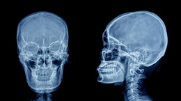 Zespół oczno-mózgowo-skórny - objawy zespołu Dellemana-Oorthuysa